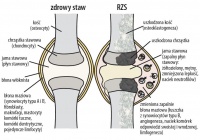 Artykuł Co warto wiedzieć na temat reumatoidalnego zapalenia stawów?